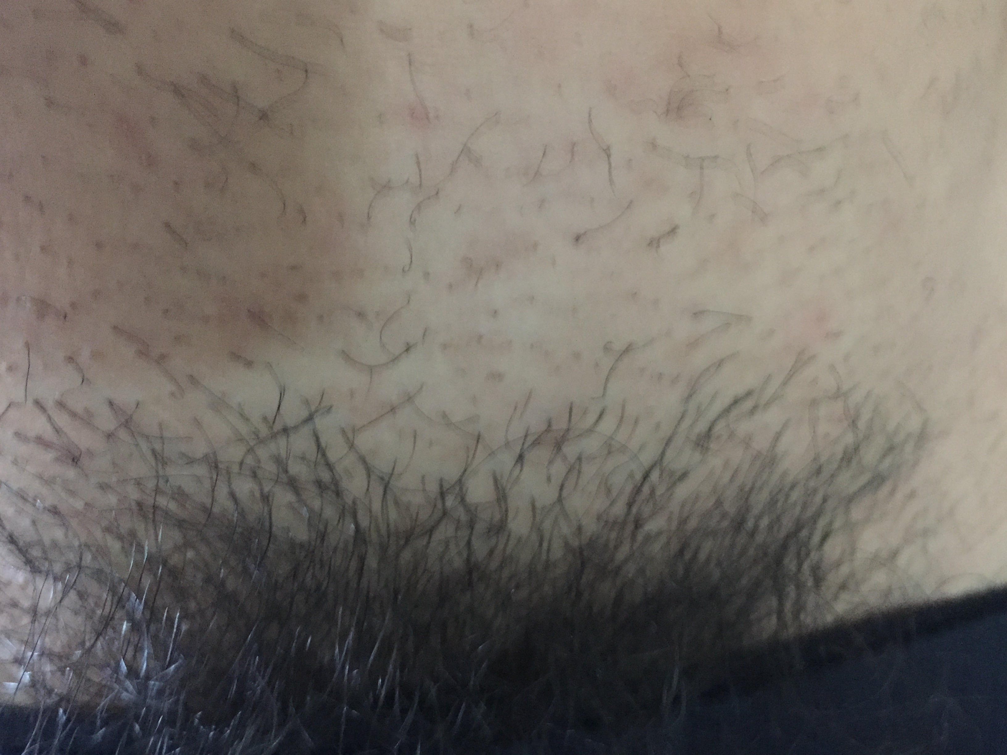 男性用脱毛器でアンダーヘアを脱毛して２週間（接写）